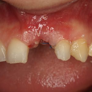 Dental-treatment